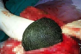 Sốc với búi tóc to bằng quả dưa trong bụng bệnh nhân