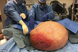 Quý bà 20 năm đeo khối u nặng bằng trọng lượng người lớn 