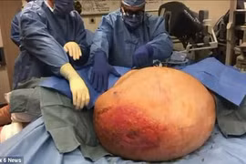 Quý bà 20 năm đeo khối u nặng bằng trọng lượng người lớn 