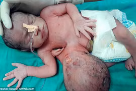 Choáng váng ca sinh đôi ký sinh kỳ lạ nhất thế giới 