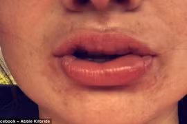 Thiếu nữ bỏng môi độ 3 vì làm trắng răng bừa bãi