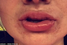 Thiếu nữ bỏng môi độ 3 vì làm trắng răng bừa bãi