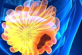 Cẩn trọng 4 dấu hiệu ung thư vú bạn chưa từng nghe