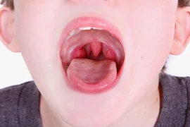 Cách điều trị viêm amiđan tại nhà không cần phẫu thuật