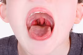 Cách điều trị viêm amiđan tại nhà không cần phẫu thuật