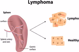 Có thể bị ung thư máu do phẫu thuật nâng ngực