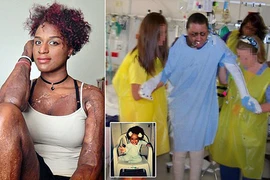 Nghịch dại với lửa và phải ghép da của người đã chết