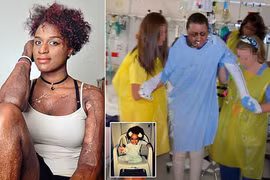 Nghịch dại với lửa và phải ghép da của người đã chết