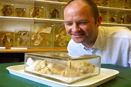 Bệnh nhân được nhìn tận mắt quả tim của mình sau 7 năm