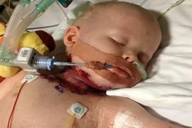 Nguy kịch vì thủy đậu biến chứng thành vi khuẩn ăn thịt người