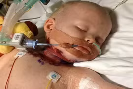 Nguy kịch vì thủy đậu biến chứng thành vi khuẩn ăn thịt người