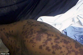 Bong da kinh hoàng suýt chết vì dị ứng thuốc chống trầm cảm