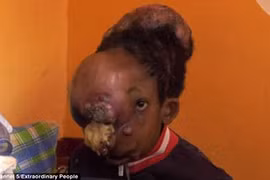 Bi kịch của cậu bé mạo hiểm tính mạng cắt u trên mặt