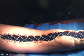 Suýt mất mạng vì bị nhiễm vi khuẩn ăn thịt người