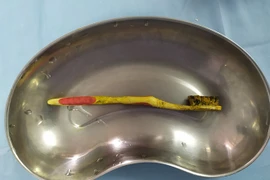 Bàn chải đánh răng hoen tróc trong tá tràng