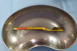 Bàn chải đánh răng hoen tróc trong tá tràng