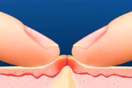 Đây là lý do bạn đừng bao giờ nặn mụn