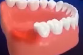 Trải nghiệm thực tế quá trình nhổ răng khôn trong chỉ với 7 phút tại Shinbi Dental