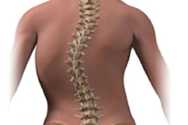 Video: Cận cảnh quá trình phẫu thuật vẹo cột sống