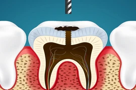 Xem cách nha sĩ nhổ răng sâu