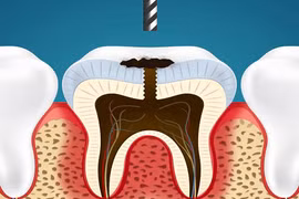 Xem cách nha sĩ nhổ răng sâu