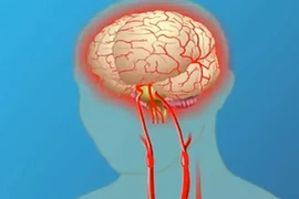 Những dấu hiệu nhận biết đột quỵ đơn giản