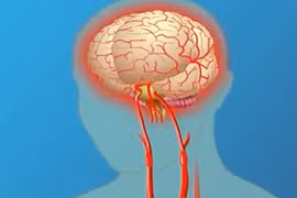 Những dấu hiệu nhận biết đột quỵ đơn giản