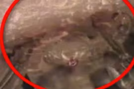 Kinh hoàng hàng trăm con rận mu bám trên mi mắt bé 6 tuổi