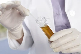 5 dấu hiệu cảnh báo ung thư thận bạn cần lưu ý