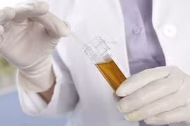 5 dấu hiệu cảnh báo ung thư thận bạn cần lưu ý