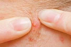 Bệnh nhân U60 tự nặn mụn... nhiễm trùng, nguy kịch tính mạng