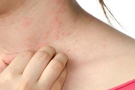 Cách chữa dị ứng thời tiết khi chuyển mùa hiệu quả nhất