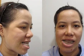 Cô giáo Bình Định thay đổi diện mạo sau phẫu thuật chỉnh hàm 