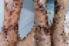 Người đàn ông viêm da nhiễm trùng nặng sau lội nước, đắp lá