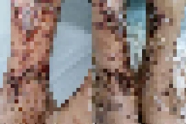 Người đàn ông viêm da nhiễm trùng nặng sau lội nước, đắp lá