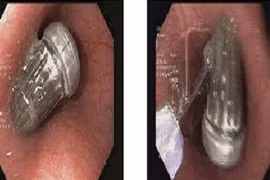 Nữ sinh vô tình nuốt bàn chải đánh răng dài 15 cm vào bụng