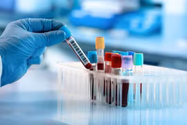 7 xét nghiệm máu không cần nhịn ăn