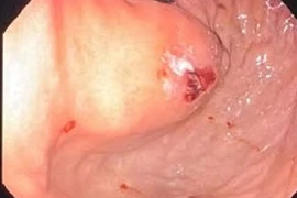 Cứu người đàn ông bị vỡ tĩnh mạch dạ dày nguy kịch