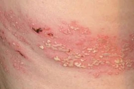 Biến chứng đáng sợ của bệnh zona thần kinh