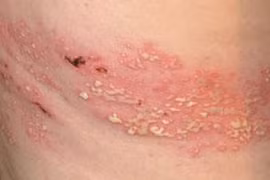 Biến chứng đáng sợ của bệnh zona thần kinh