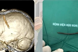 Cân não sinh tử, cứu sống người bệnh bị đinh đóng xuyên sọ