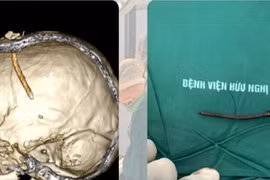Cân não sinh tử, cứu sống người bệnh bị đinh đóng xuyên sọ