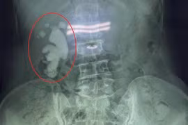 Sỏi san hô lớn lấp đầy thận phải người phụ nữ 65 tuổi