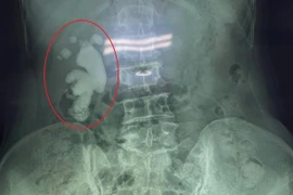 Sỏi san hô lớn lấp đầy thận phải người phụ nữ 65 tuổi