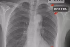 Cô gái gãy 3 xương sườn sau cái ôm của đồng nghiệp