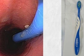 Hy hữu: Nuốt cả bàn chải đánh răng...khi tự “giải cứu” nghẹn họng