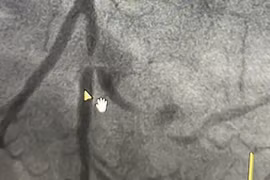 Đau ngực dữ dội... coi chừng bị nhồi máu cơ tim