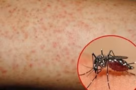 Cảnh báo nguy cơ sốt xuất huyết Dengue bùng phát 