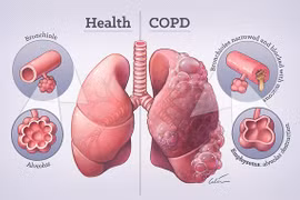 Cách đối phó với bệnh phổi tắc nghẽn hơn 380 triệu người mắc