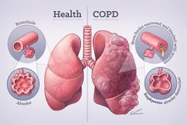 Cách đối phó với bệnh phổi tắc nghẽn hơn 380 triệu người mắc